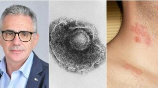 Aumentano i casi Fuoco di Sant’Antonio, Pregliasco: “Fate attenzione agli occhi se.. Altro…