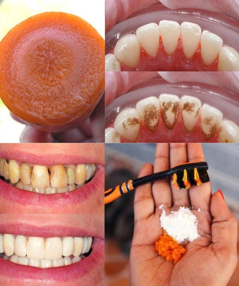 Come sbiancare i denti in 2 minuti?