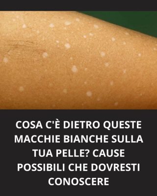 Cosa c’è dietro queste macchie bianche sulla tua pelle? Cause possibili che dovresti conoscere