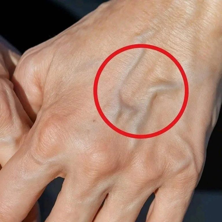 🔴 Se le tue vene le vedi così significa che.. Altro…