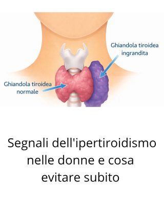 Segnali dell’ipertiroidismo nelle donne e cosa evitare subito